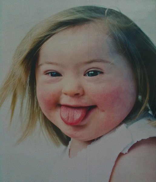 Лицо Дауна девушки