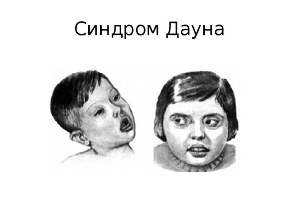 Рисунки людей с синдромом Дауна