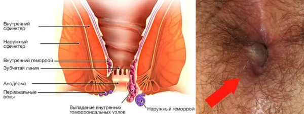 Геморройный узел наружный