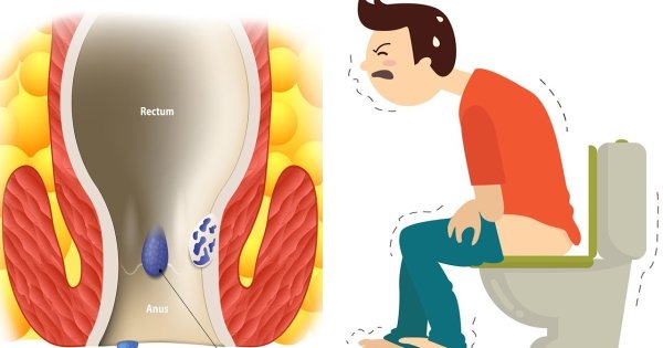 Гемаройни уй ШАРОЙИТИДА даволаш