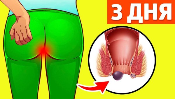 Внешний геморроидальный узел