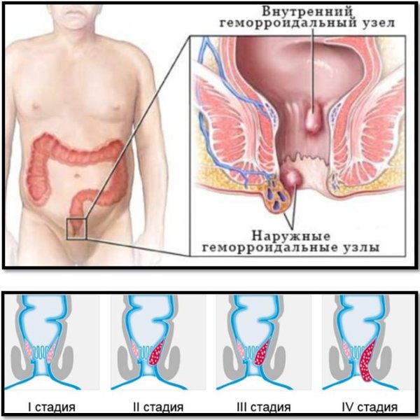 Проявления геморроя признаки