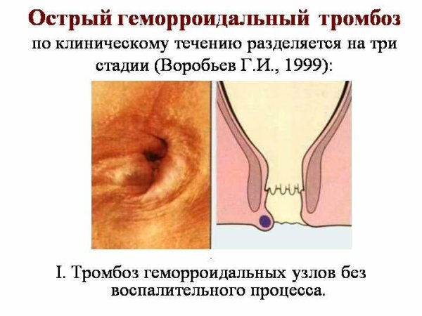 Свечи в прямую кишку