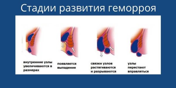 Геморрой узел наружный тромбоз