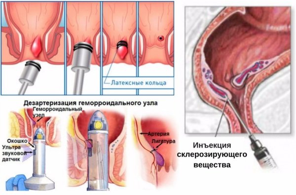 Понос карикатура