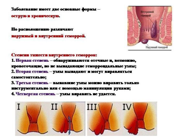 Дезартеризация геморроидальных узлов