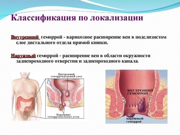 Внутренний геморрой толстой кишки