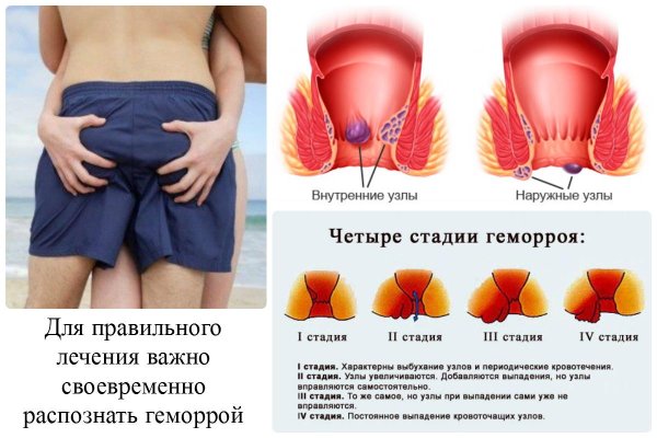 Операция иссечение анальной трещины