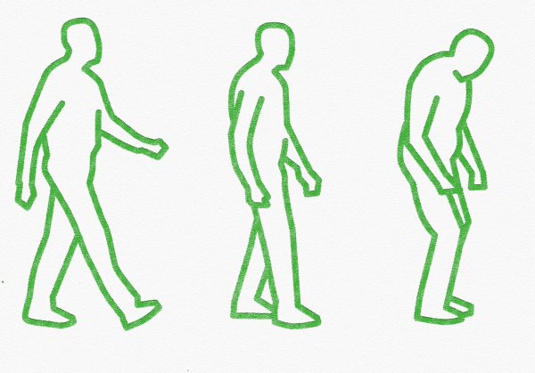 Болезнь Паркинсона походка