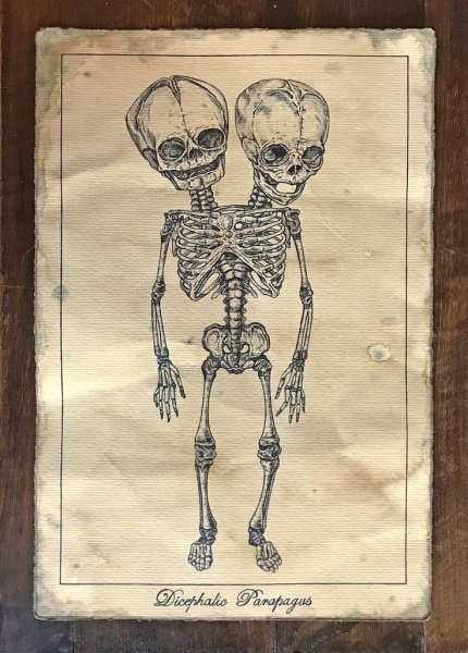 Рисунок сиамских близнецов