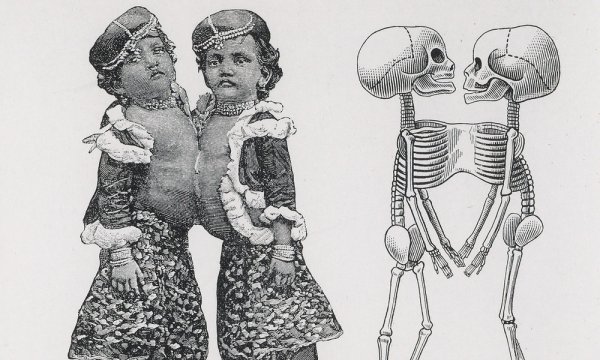 Анатомия сиамских близнецов