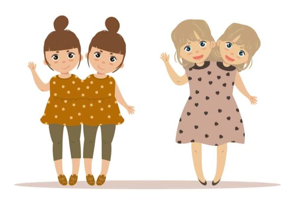 Скелет сиамских близнецов Кунсткамера