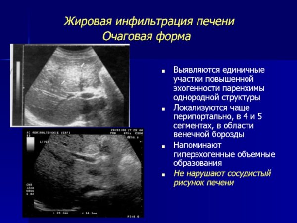 Жировая инфильтрация печени УЗИ картина