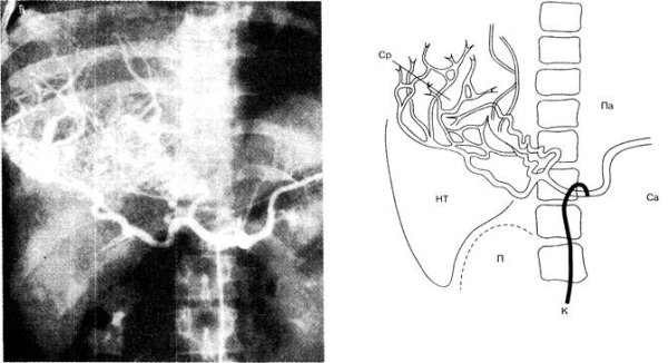 Селективная ангиография чревного ствола