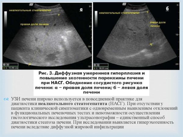 УЗИ признаки стеатоза печени: