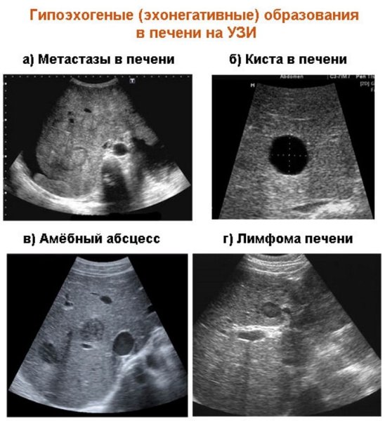 Венозная система печени анатомия