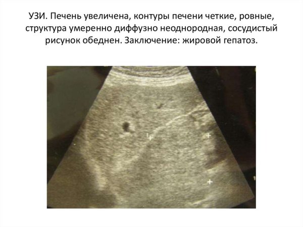 Кровоснабжение печени воротная Вена