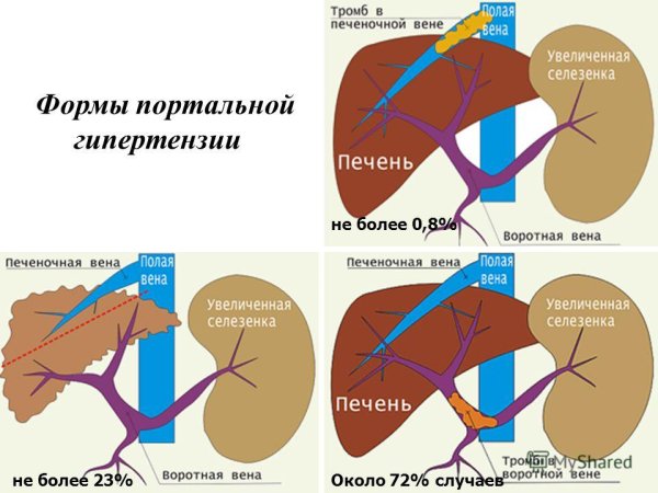 Непаразитарные кисты печени клинические рекомендации