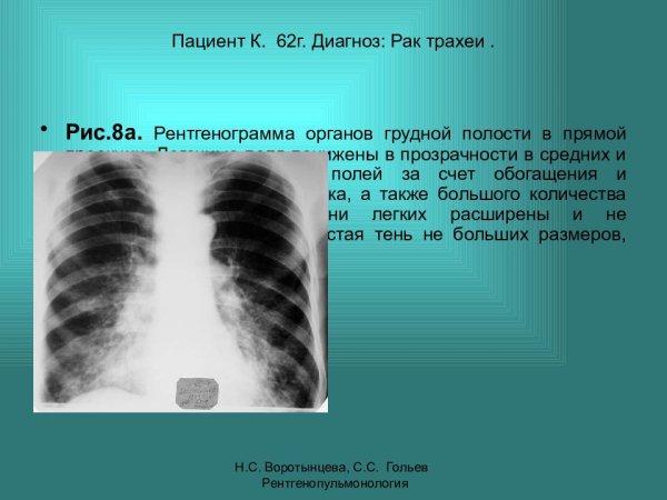 Изменение легочного рисунка