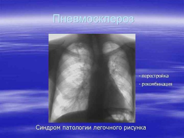 Изменение легочного рисунка