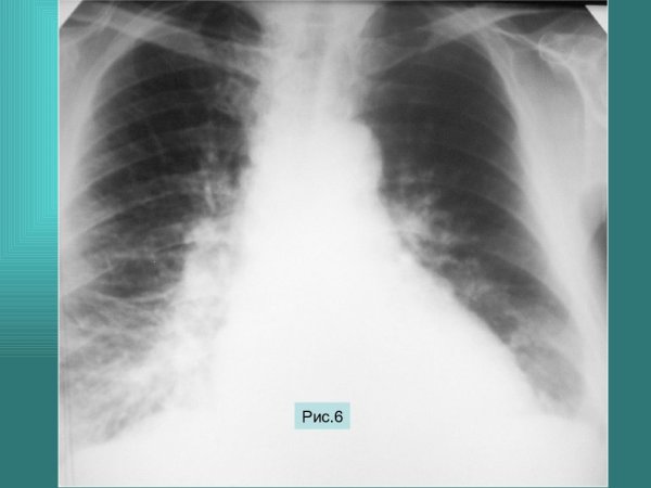 Легочный рисунок