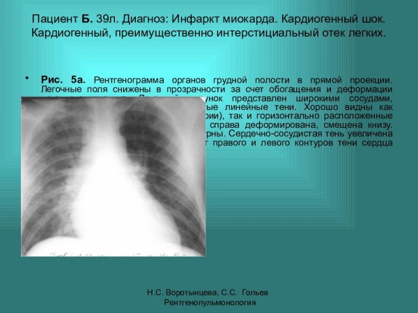 Токсико аллергический альвеолит