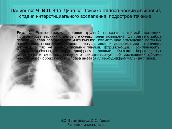 Синдромы патологии органов дыхания