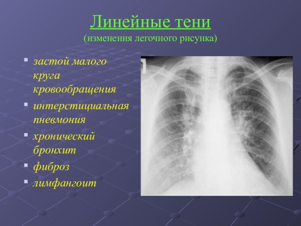 Изменение легочного рисунка