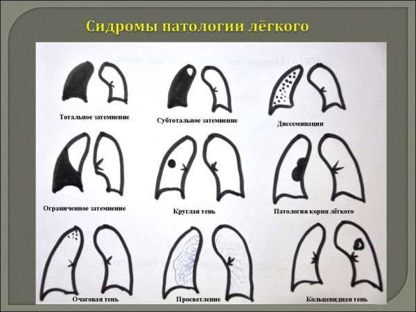 Синдром деформации легочного рисунка