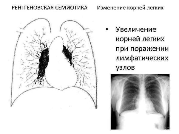Легочный рисунок деформирован
