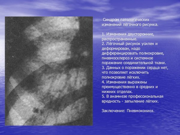 Мозаичность легочного рисунка