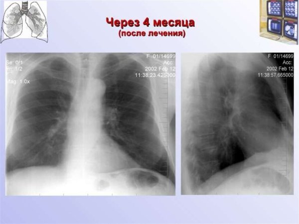 Расширение корней легких рентген