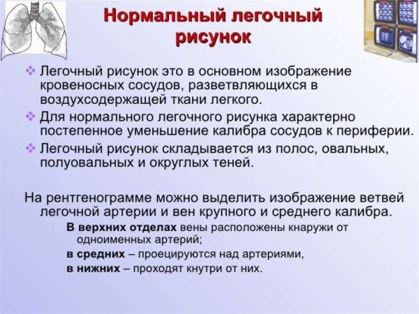 Инфильтративный бронхоаденит рентген