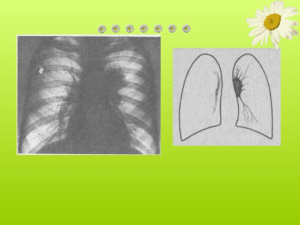 Обеднение легочного рисунка