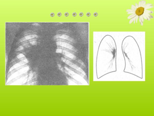 Крупозная пневмония рентгенограмма грудной клетки