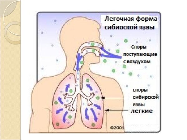 Легочная форма сибирской язвы