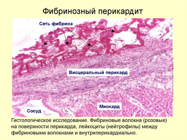 Фибринозный перикардит микропрепарат