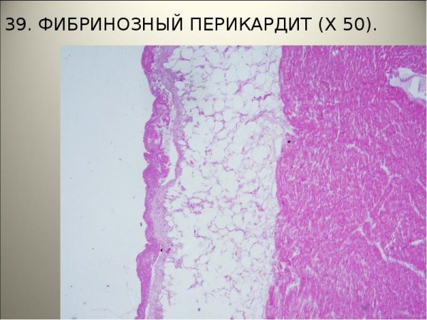 Фибринозный перикардит патанатомия
