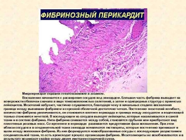 Фибринозно-Гнойный перикардит гистология