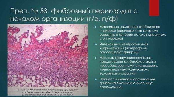 Фибринозный перикардит - окраска гематоксилином и эозином