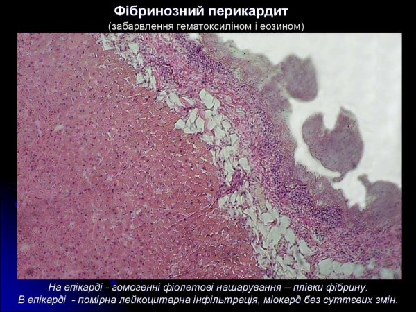 Фибринозный перикардит патанатомия
