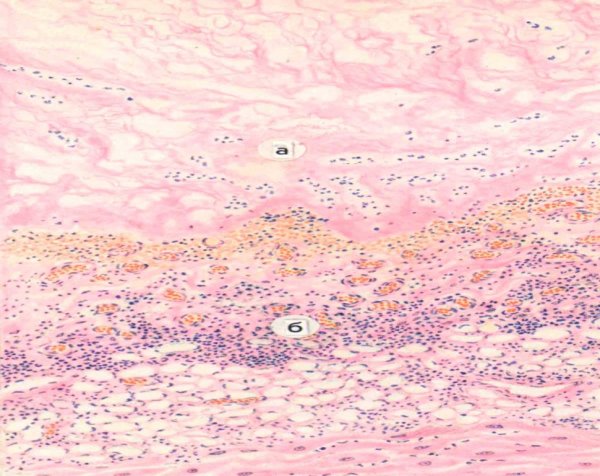 Фибринозный перикардит патологическая анатомия
