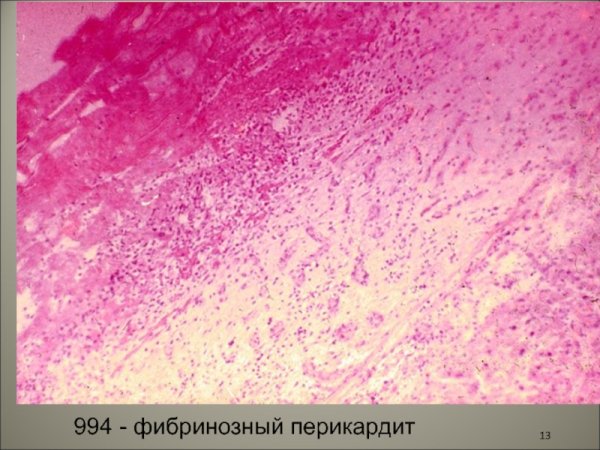 Фибринозный перикардит патологическая анатомия