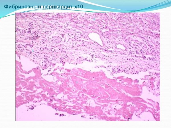 Фибринозный перикардит патанатомия