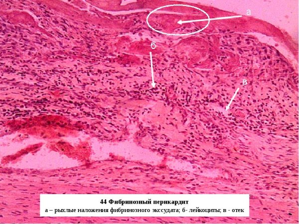 Фибринозный перикардит гистология