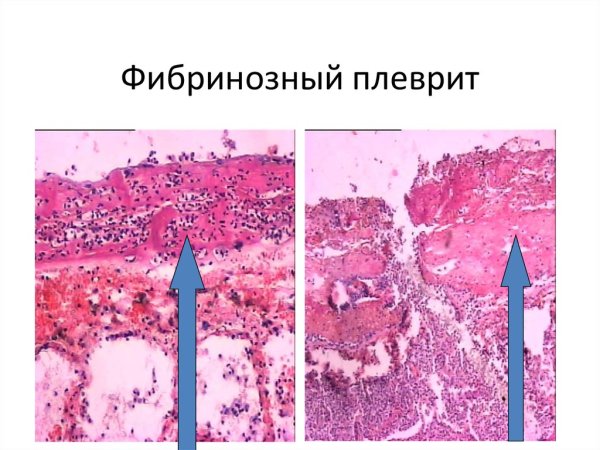 Фибринозный плеврит патологическая анатомия