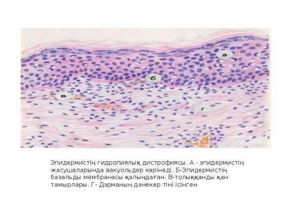 Фибринозно-Гнойный плеврит микропрепарат рисунок