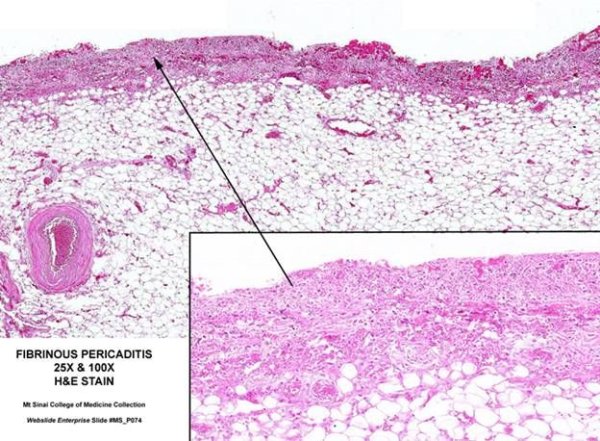 Фибринозный перикардит гистология