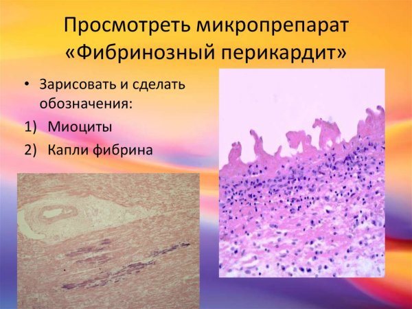 Фибринозный перикардит препарат патанатомия