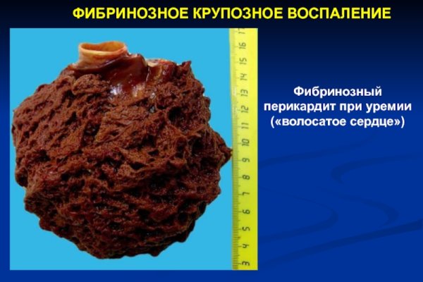 Фибринозный перикардит КРС